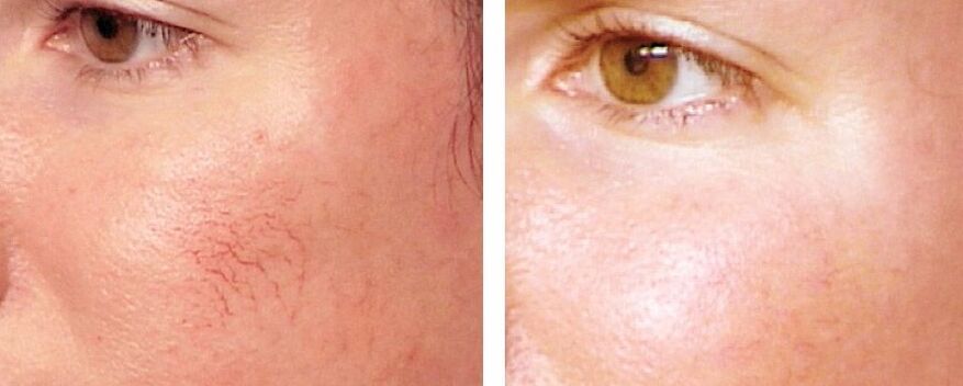 Removing Rosacea