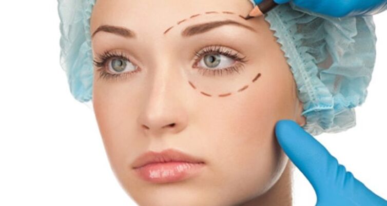 Surgical lifting
