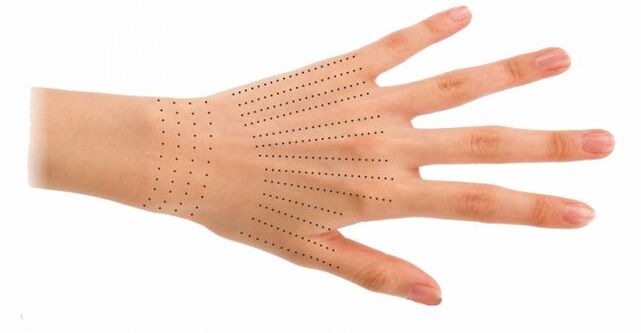 Hand injection sites during biorevitalization
