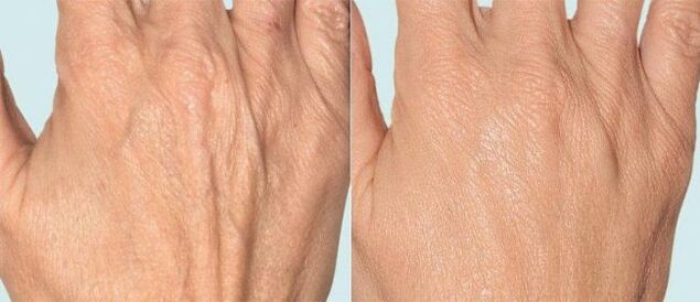 Hand skin before and after fractional therapy