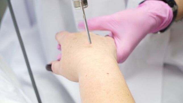 Laser rejuvenation of the skin of the hands