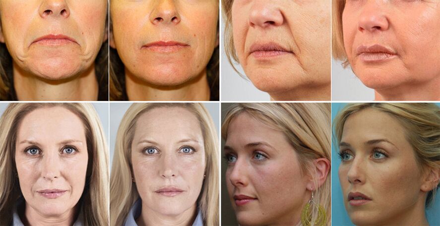 photos of women before and after facial rejuvenation